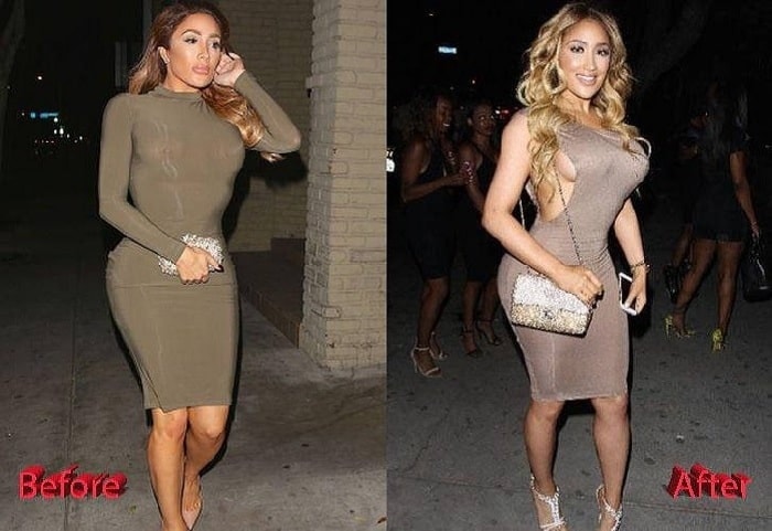 A picture of Nikki Baby before and after butt augmentation.